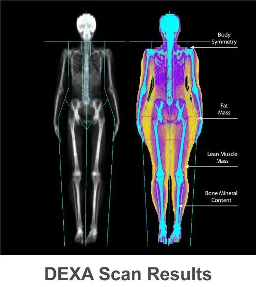 DEXA SCAN