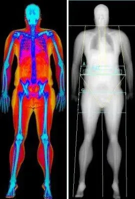 DEXA SCAN